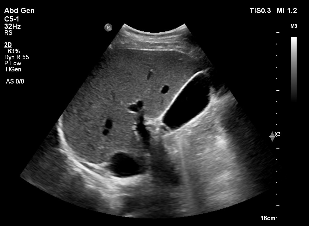 Pamje ne eko te melcise gjate ekzaminimit me ultratinguj